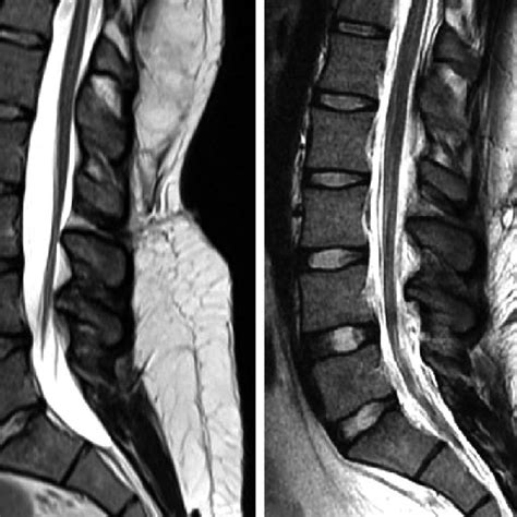Preoperative Axial And Sagittal T2 Weighted Lumbar Mr Images Of The