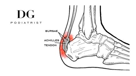 Heel Pain Heel Bursitis