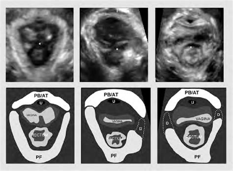 Transperineal Ultrasound Of The Pelvic Fl Oor Left Normal Middle