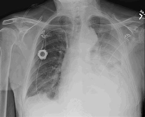Pleural Pigtail Catheter Malpositioned In Thoracic Aortic Aneurysm Sac
