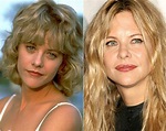 Meg Ryan Plastic Surgery Before And After Photos Lip Implants, Botox