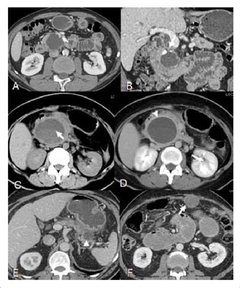 Pancreatic Pseudocyst A Axial Post Contrast Ct Scan Shows 3 Cm