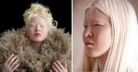 Abandoned Albino Baby Grows Up To Become A Vogue Model Raising