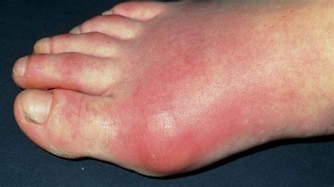 Uk Gout Rates Sharp Rise In Number Of Sufferers Bbc News