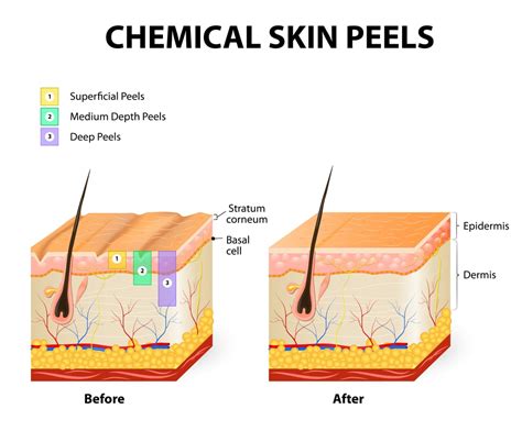 Chemical Peel Procedure Overview