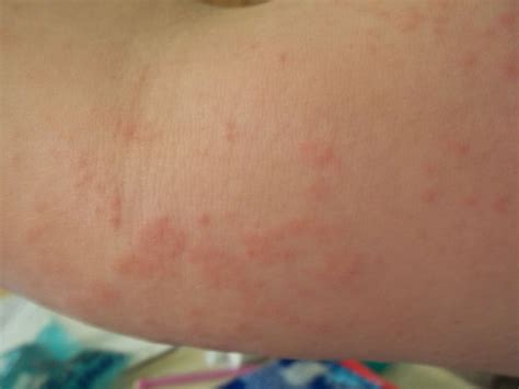 Rash On Arm Pictures Photos