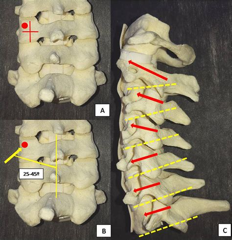 Posterior Subaxial Cervical Spine Screw Fixation A Review Of Techniques Andrei Fernandes