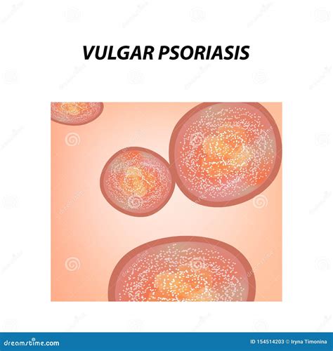 Vulgar Psoriasis Not Pustular Type Of Psoriasis Eczema Skin Disease