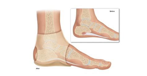 Pin On Plantar Fasciitis Info And Products
