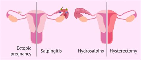 Salpingectomy How And Why Are The Fallopian Tubes Extracted