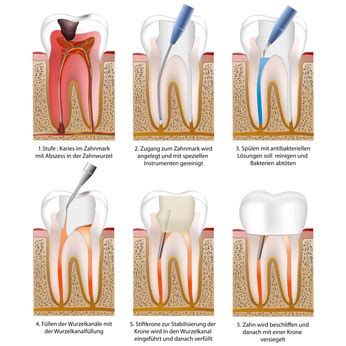 Maschinelle Wurzelkanalbehandlung Zahnarztpraxis Kaya Herne
