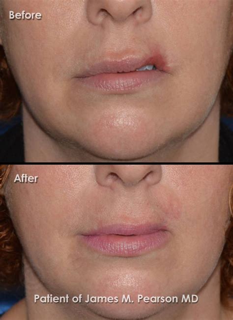 plastic surgery lips before after
