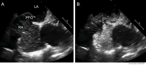 Current Indications For Percutaneous Closure Of Patent Foramen Ovale