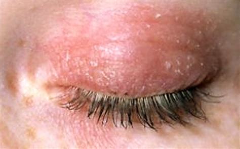 Blepharitisandmeibomitis Aka Dirty Eyelids Optometry Blog Wink Optometry