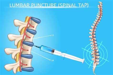 6 Side Effects Of Lumbar Puncture Spinal Tap In Babies