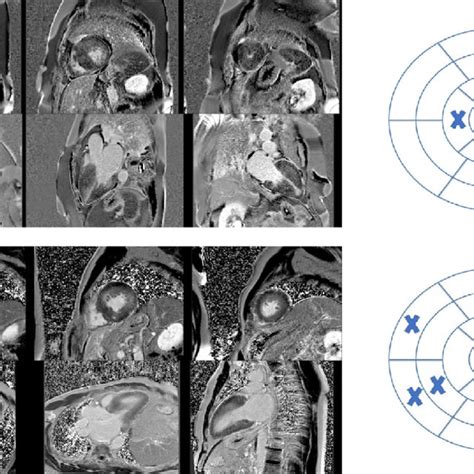 Cardiac Magnetic Resonance Imaging Of Two Patients With Hypertrophic