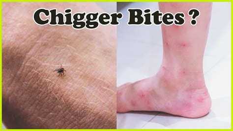 How To Get Rid Of Chiggers In Garden