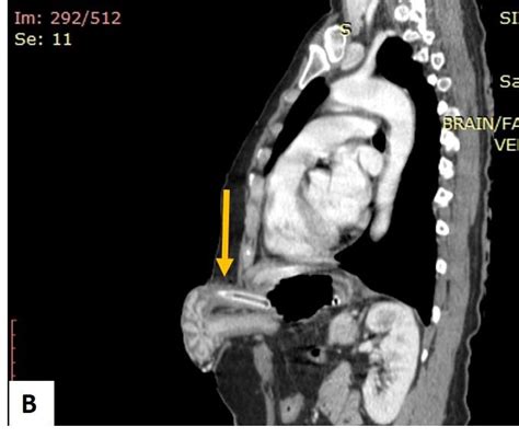 Penetrating Stab Injury With Herniation Of Stomach Through Anterior