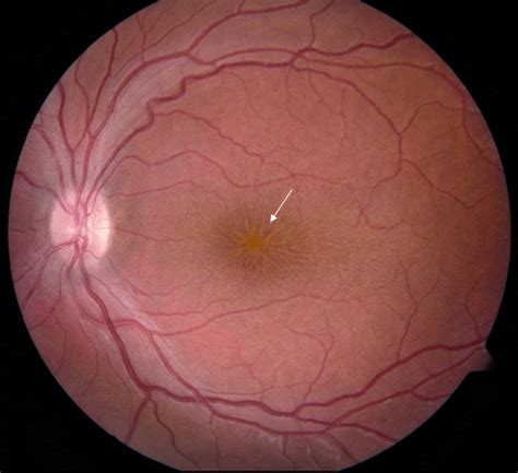 Peripheral Lesions Of The Retina Dr Carlo Benedetti
