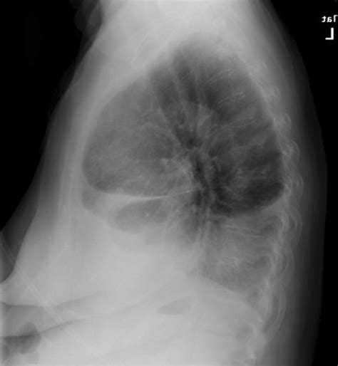 Loculated Pleural Effusion Chest X Ray Carlie Doherty