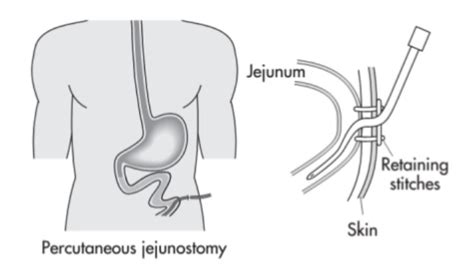 Interventional Radiology Equipment Jejunostomy Tubes J Tubes Stepwards
