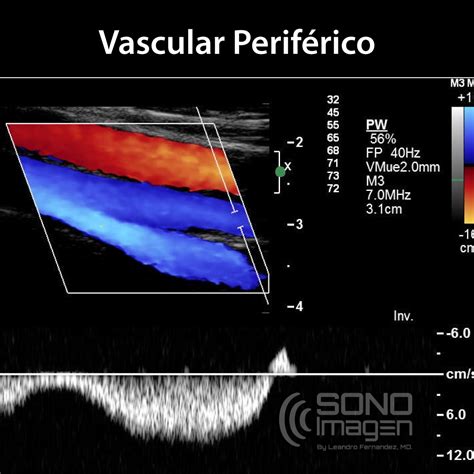 Curso Doppler Vascular Periférico Modo Virtual Sonoimagen By Leandro