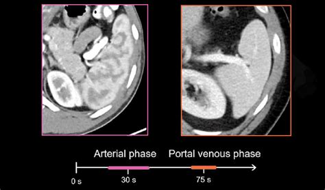 Abdominal Ct Spleen And Adrenal Glands • Litfl • Radiology