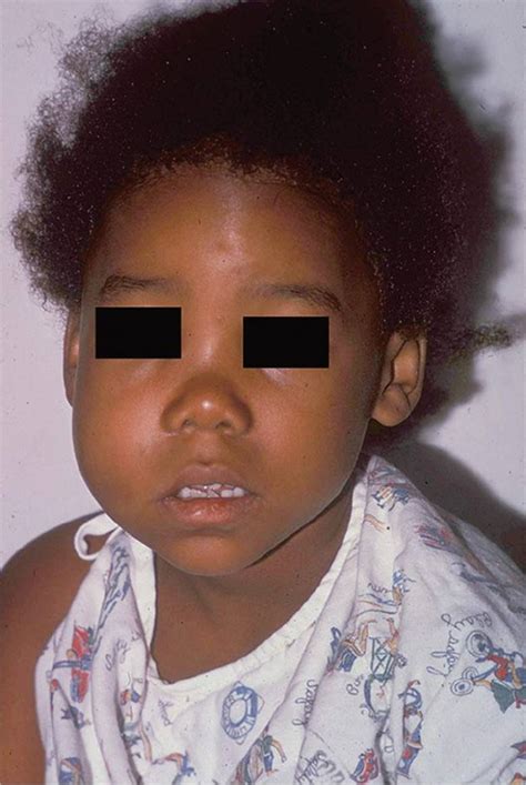 Lumps On The Face Visual Diagnosis And Treatment In Pediatrics 3 Ed