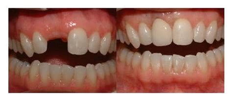 Implante Dentário Fotos De Antes E Depois