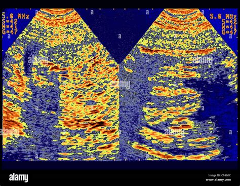 Kidney Ptosis Ultrasonography Stock Photo Alamy