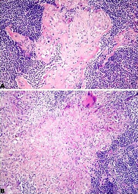 Metastatic Squamous Cell Carcinoma Urinary Bladder Coexisting With
