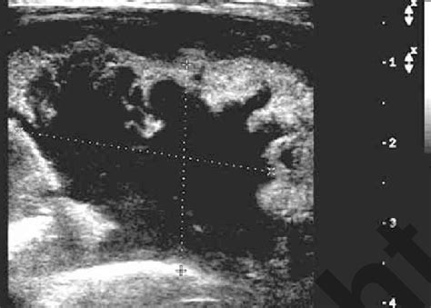 Ultrasound Shows Fluid Filled Mass In Left Groin Region Figure 5