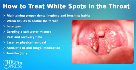 White Bumps In Throat Cedag Media Tonsil