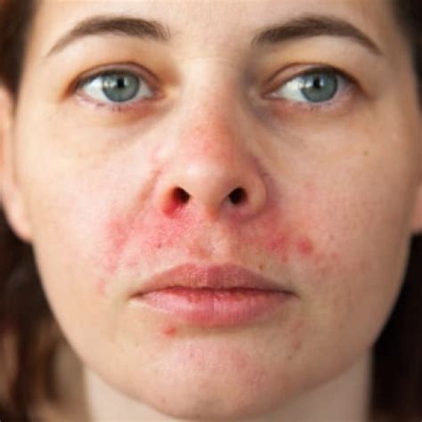 Periorale Dermatitis Behandlung And Diagnose Direkt Vom Online Hautarzt