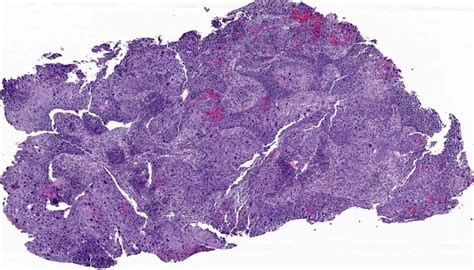 Pathology Outlines Hpv Associated Cervical Squamous Cell Carcinoma