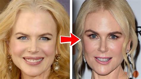 What Changes Did Nicole Kidman Make To Her Face Youtube