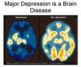 How Much Is Depression Medication Photos