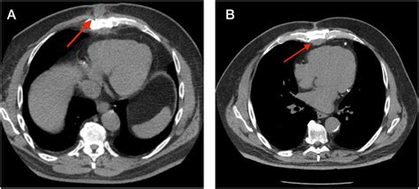 Axial Thoracic Computed Tomography Ct Image Showing Soft Tissue