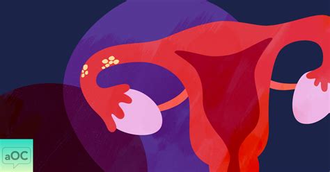 Does Ovarian Cancer Begin In The Fallopian Tube Or Ovaries