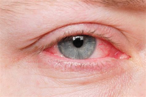 What Is Producing So Much Pink Eye Adult Guest Blog Posting Website For Australia