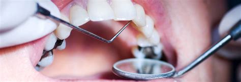 Dental Cavity Treatment In India Tooth Cavity Treatment Near Me