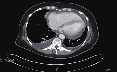 Bilateral Pleural Effusion Ct Scan Comparative Interp