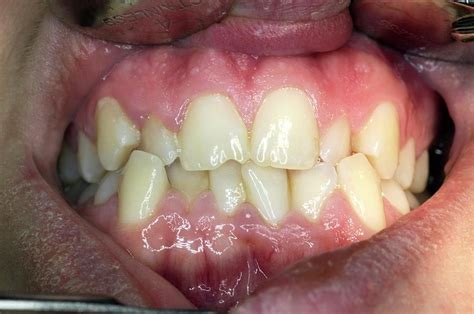 Dental Malocclusion Photograph By Dr Armen Taranyan