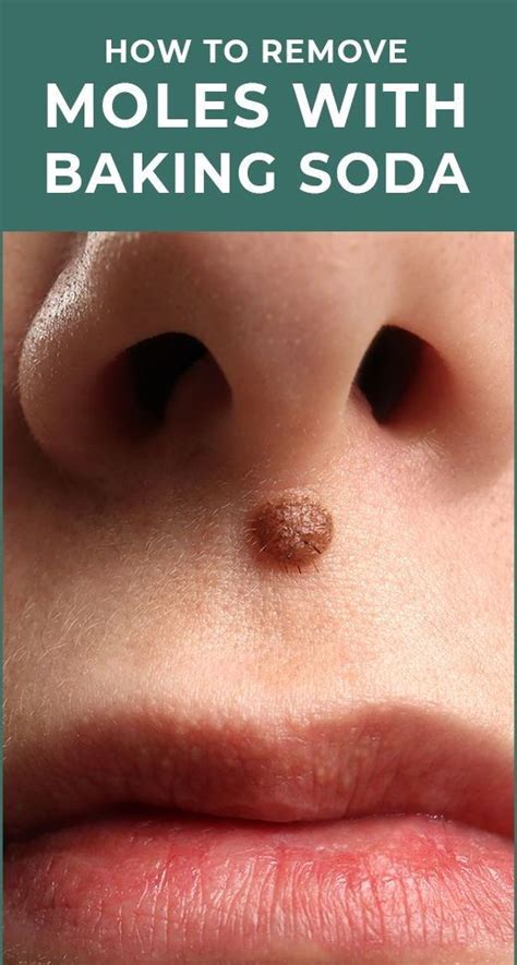 How To Remove Moles Warts Blackheads Skin Tags And Age Spots