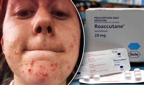 Acne Treatment Roaccutane Gave 24 Year Old Woman Pancreatitis Express
