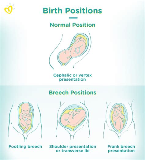 Breech Baby Meaning Causes And Birth Pampers