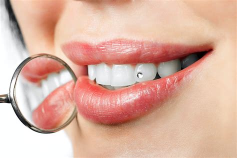 Tooth Jewelry Your Caring Sunshine Coast Dentist Hinterland View Dental