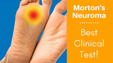 Mortons Neuroma Best Clinical Test Youtube