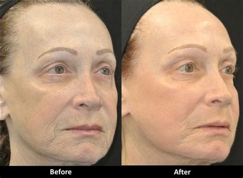 Fractional Co2 Laser Resurfacing Before And After Med Spa In Encino