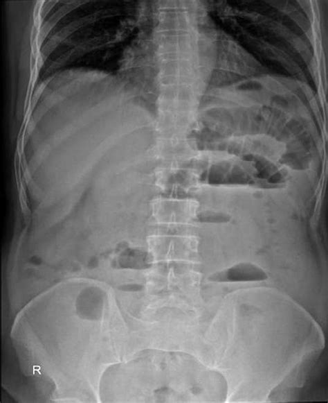 Ray Abdomen Showing Multiple Dilated Small Bowel Loops With Air Fluid
